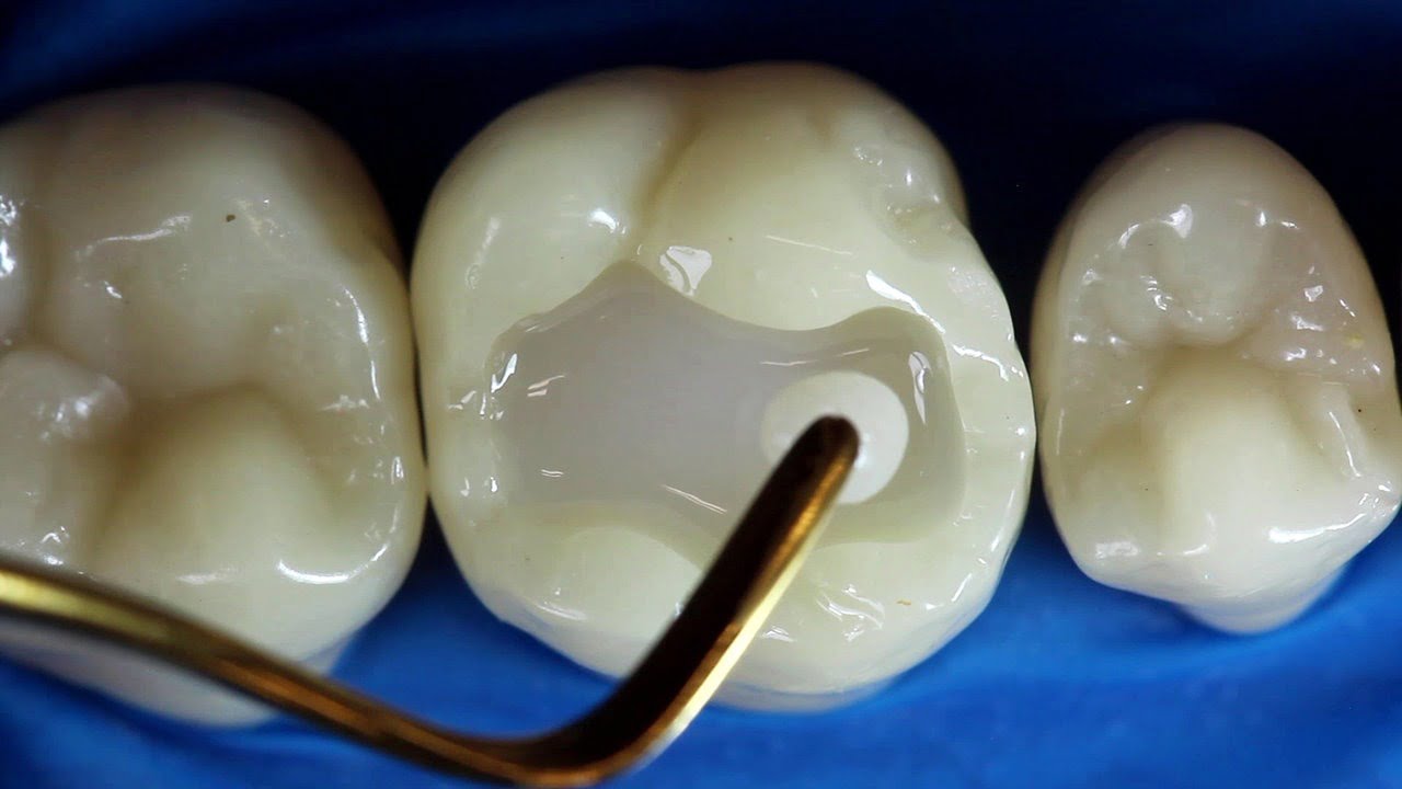 https://yongedentalcare.com/wp-content/uploads/2024/06/12_tooth_repair.jpg