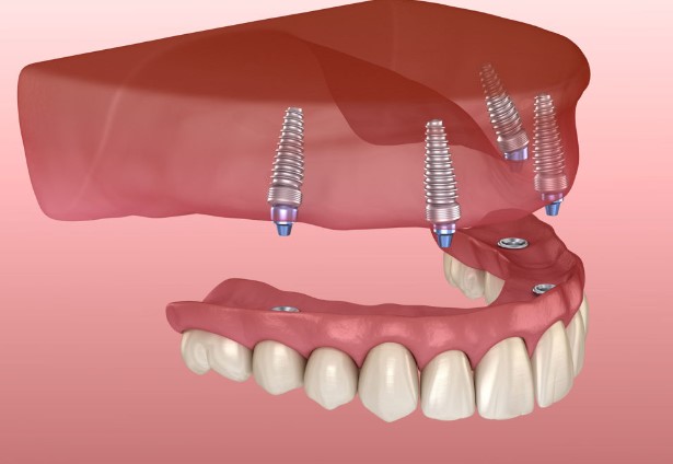 Dental Office North York. Implant supported upper denture.