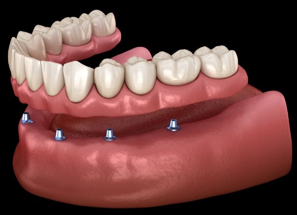 Philips Zoom Whitening in Kitsilano