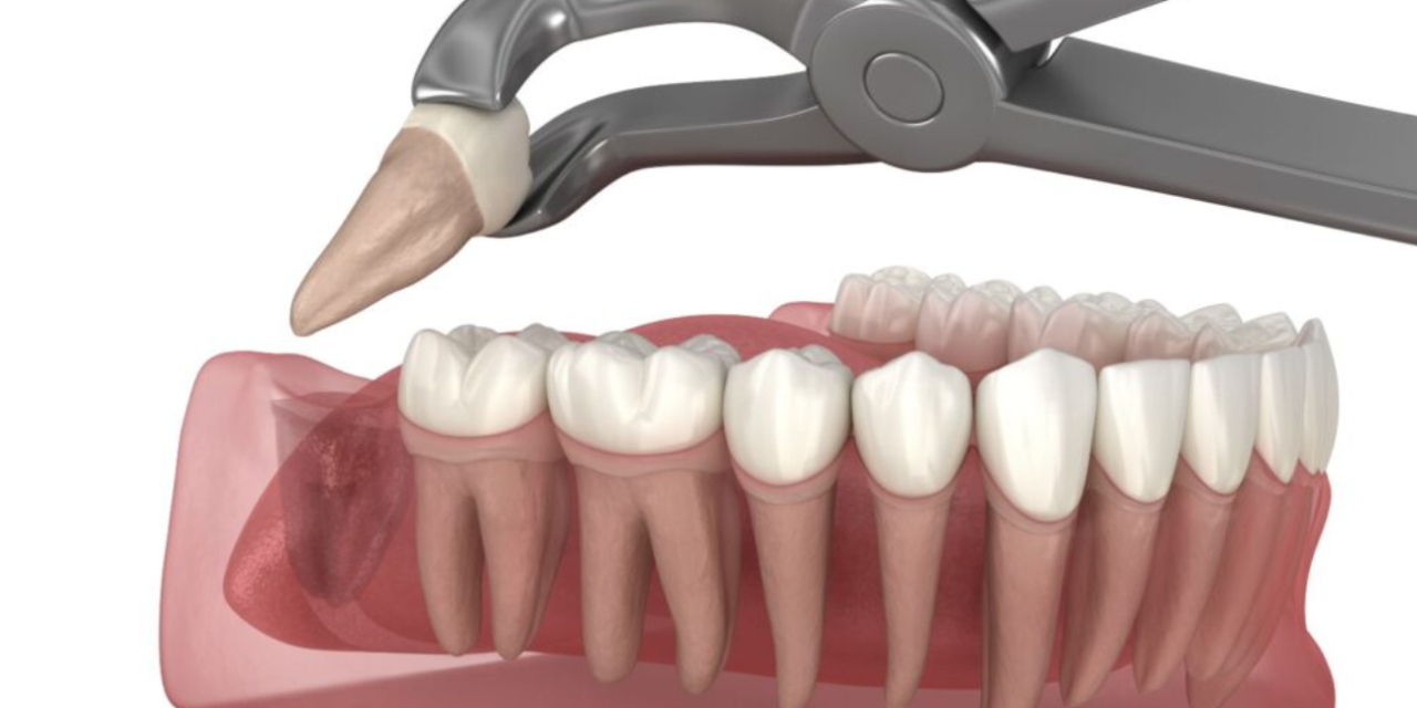 Dentist in Woodbridge, Ontario | Root Canal Treatment