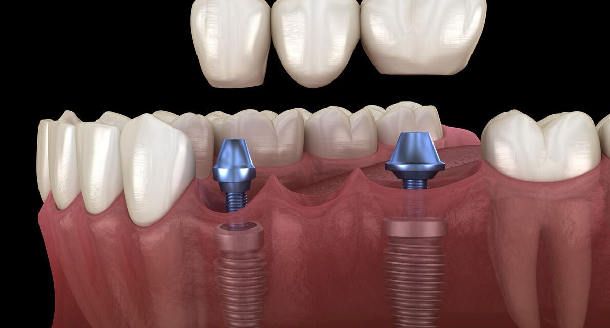 Restore Missing Teeth Safels and Effectively