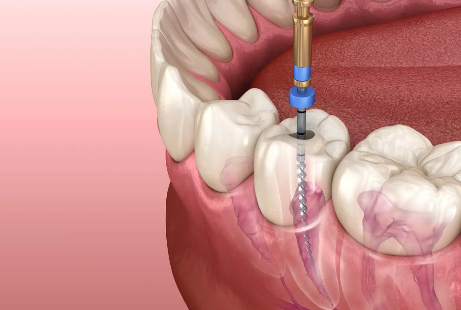 How Long Does it Take for a Root Canal Procedure