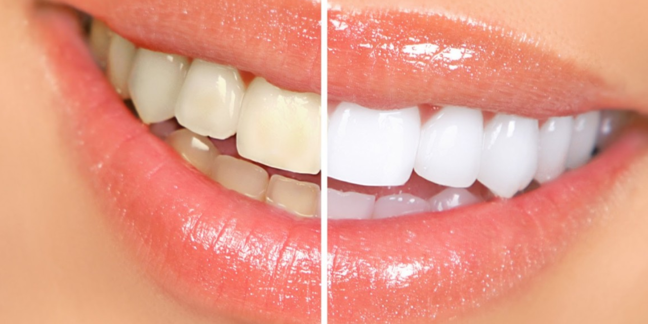 How Much is a Teeth Whitening?