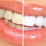 How Much is a Teeth Whitening?