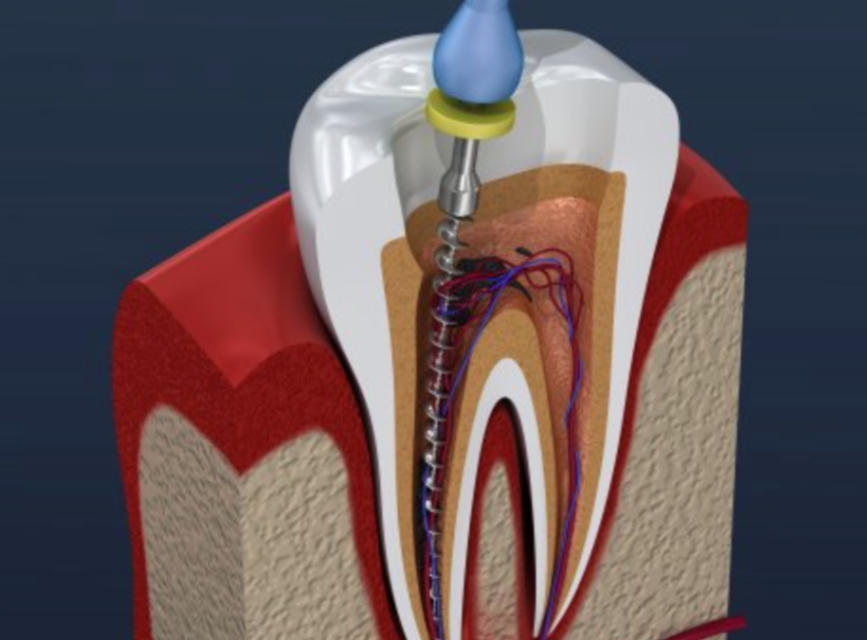 How to avoid root canal?