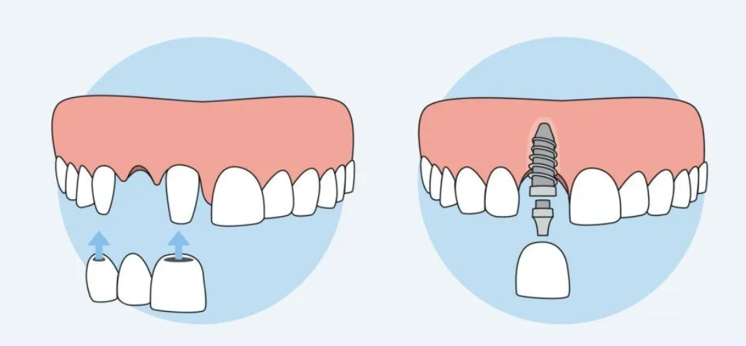 Tooth implant vs dental bridge