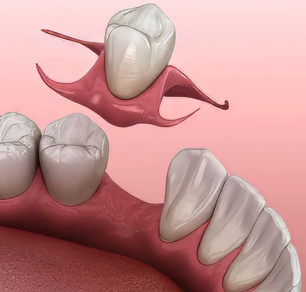 Partial Denture for One Tooth