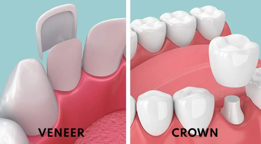 Dental Crown Vs Veneer