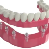 Care-For-Full-Arch-Dental-Implants.jpg