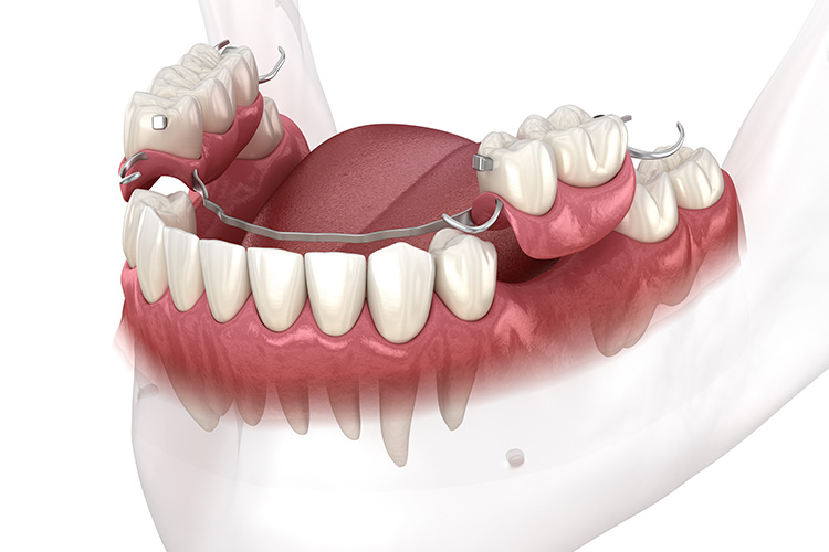 Dental Flipper VS Partial Denture